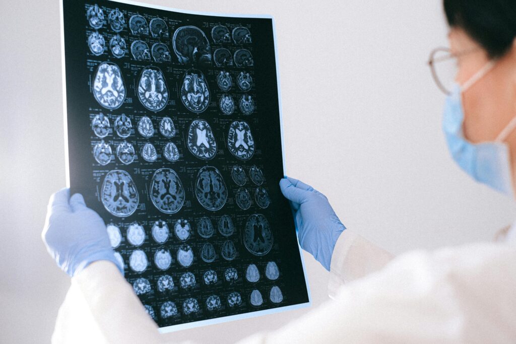 l’immagine rappresenta un medico che sta analizzando degli esami diagnostici per l'alzheimer